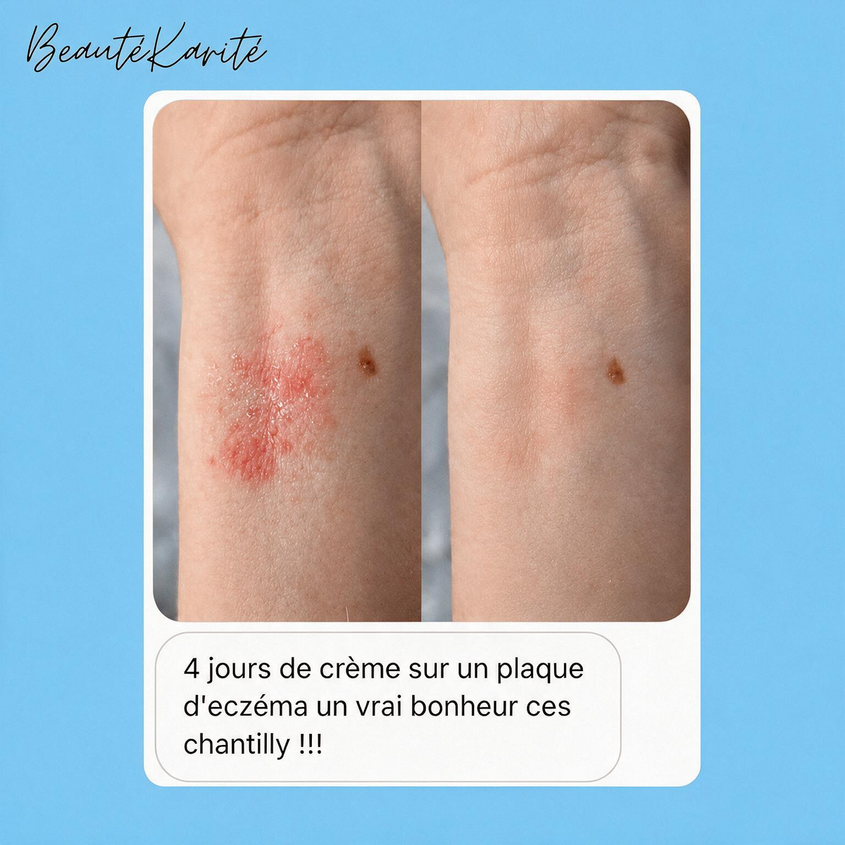 Chantilly Karité | Eczema & Peaux Réactives